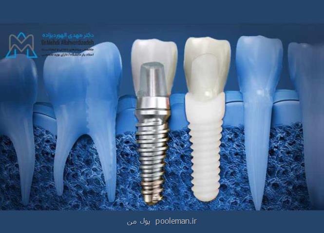 مزایای ایمپلنت دندان